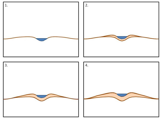Figure 3: Formation of an alluvial ridge. Note that deposition builds up natural levees on each side of the stream as well as in the bed of the stream.